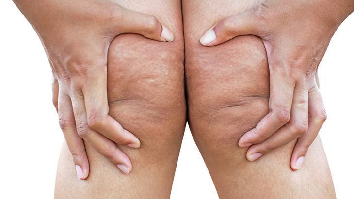 lipodem kadinlarin sessiz cigligi neden kilo veremiyorum diyenler icin cevap 2WBxOVRf.jpg